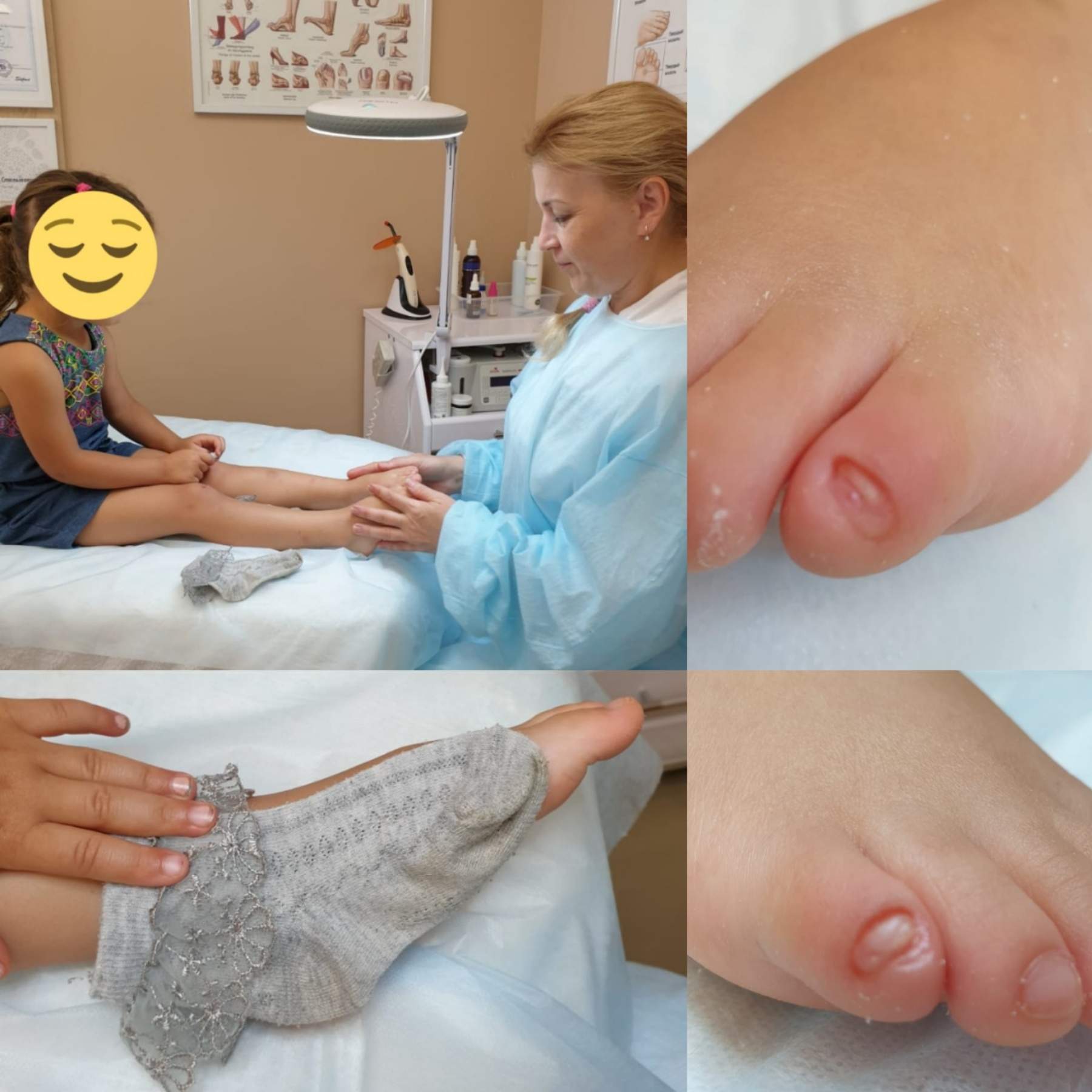 Дистрофия и грифоз ногтевой пластины у детей. Детский подолог в Симферополе.