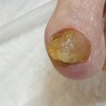 грибок ногтя
