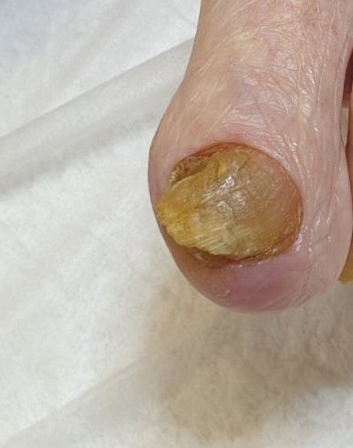 Характеристика онихолизиса и грибковой инфекции ногтей