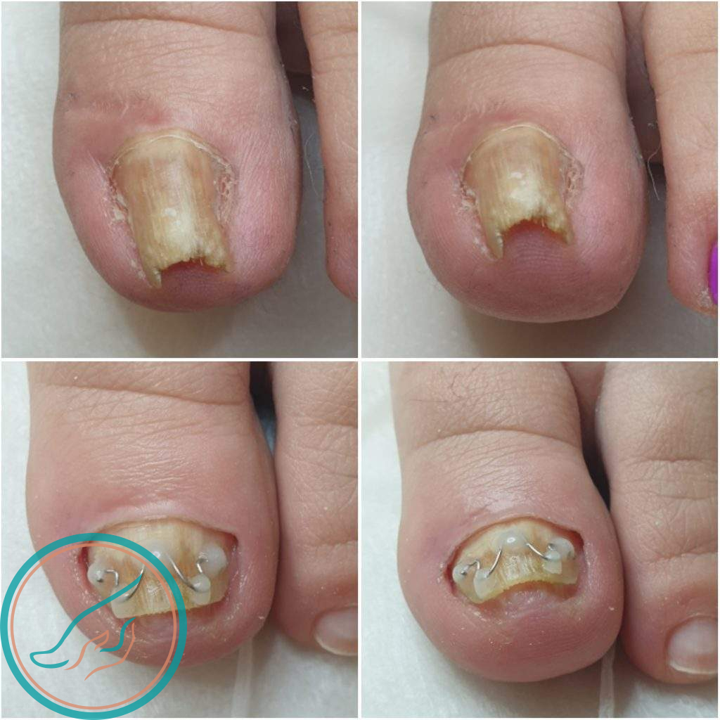 Скрученные ногти, лечение и восстановление