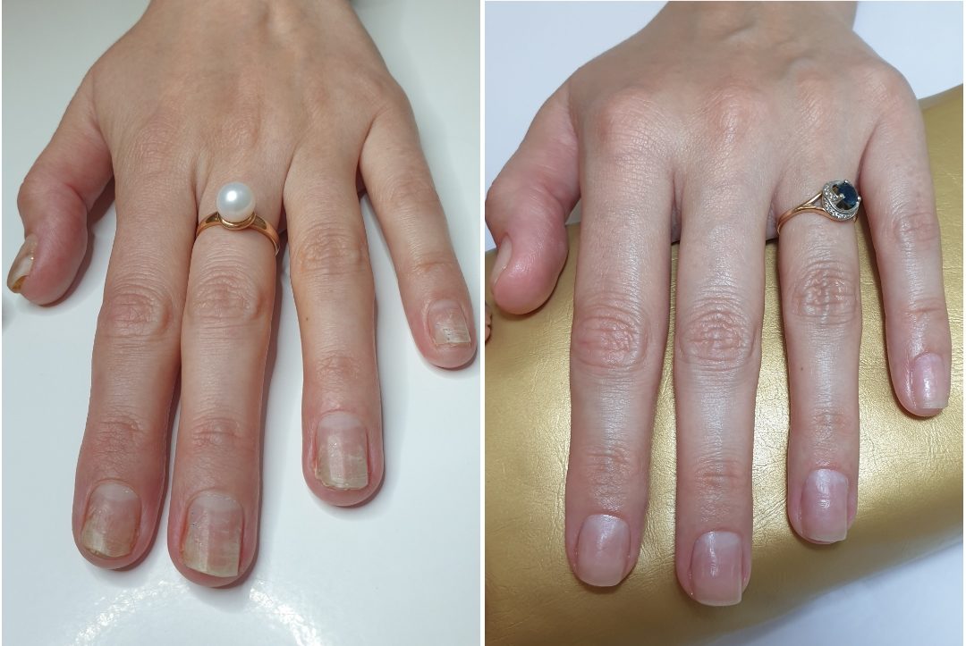 Онихолизис ногтей на руке