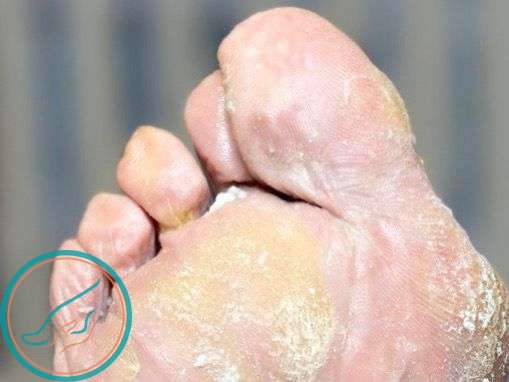Грибок ногтей на ногах: симптомы, первые признаки, причины, как определить болезнь