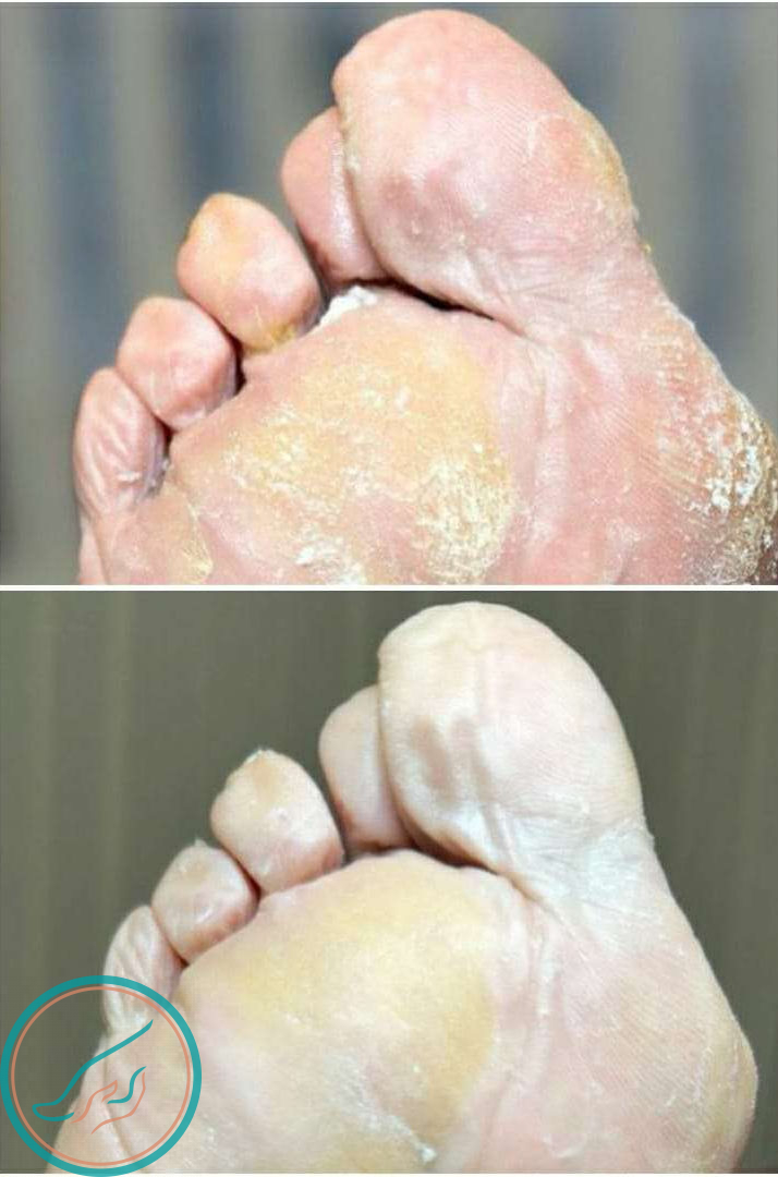 Грибок на пальцах ног до и после