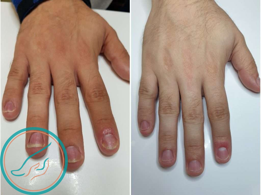 Псориаз ногтей, до и после лечения