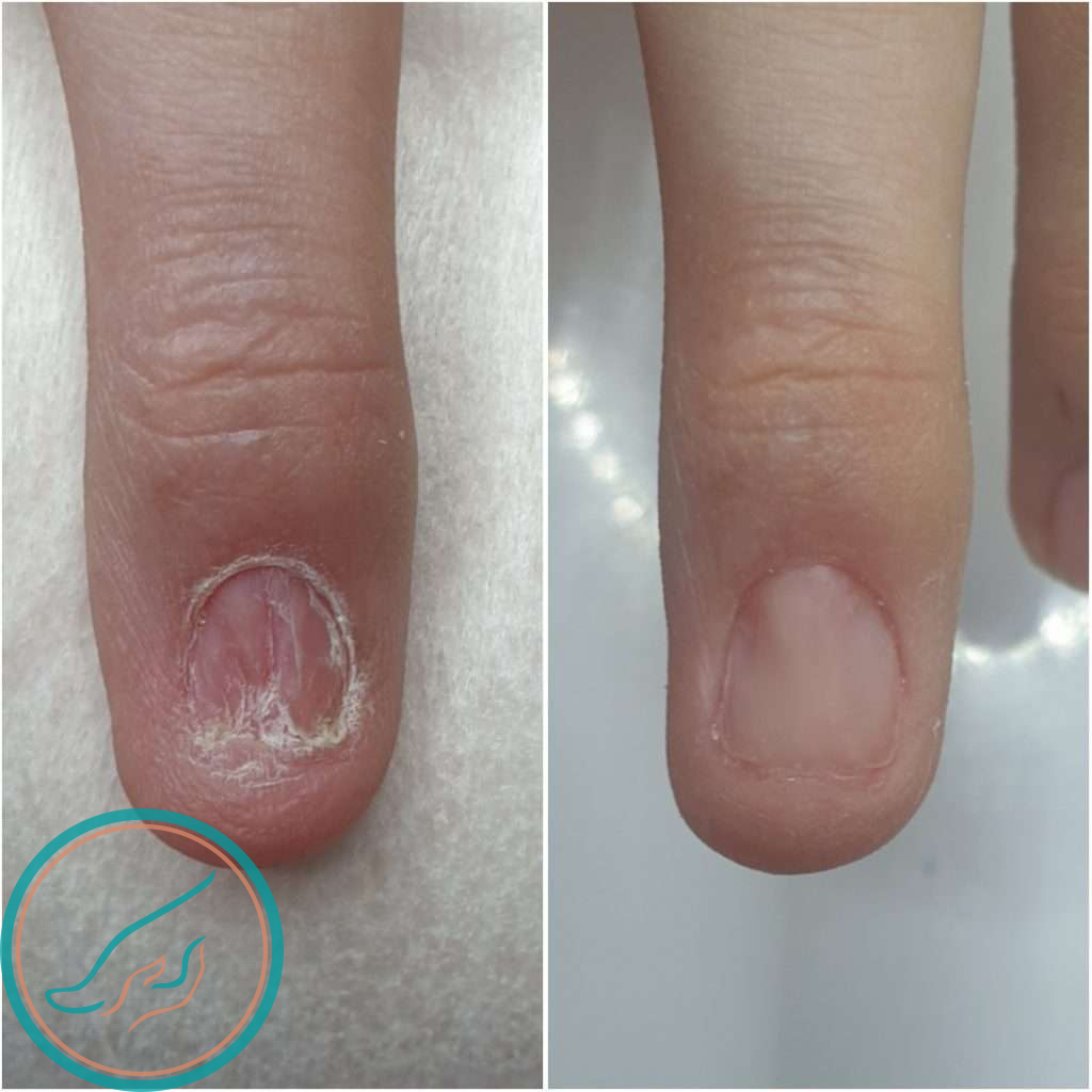 Протезирование ногтя, до и после